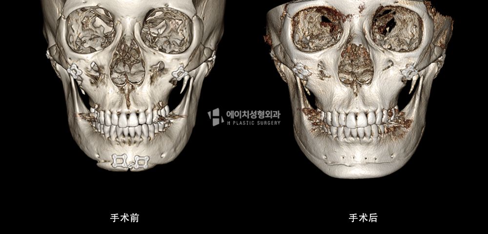 3D FIT 下颌角修复手术案例3(图9)