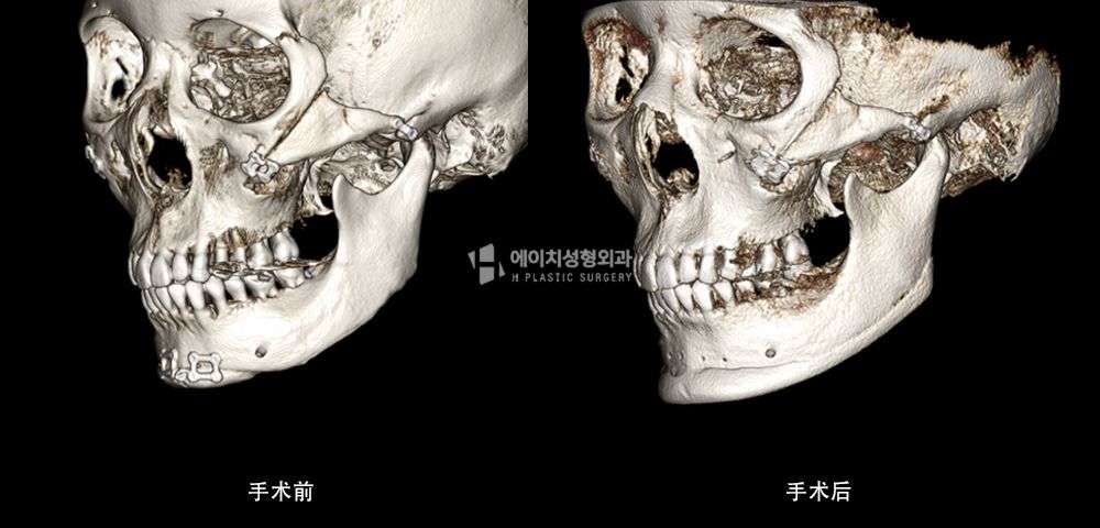 3D FIT 下颌角修复手术案例3(图10)