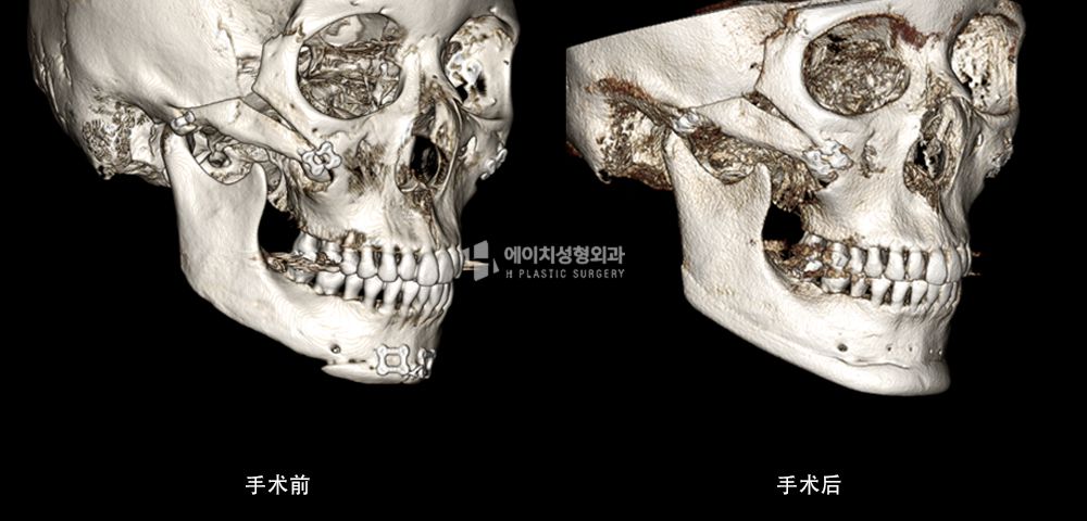 3D FIT 下颌角修复手术案例3(图11)