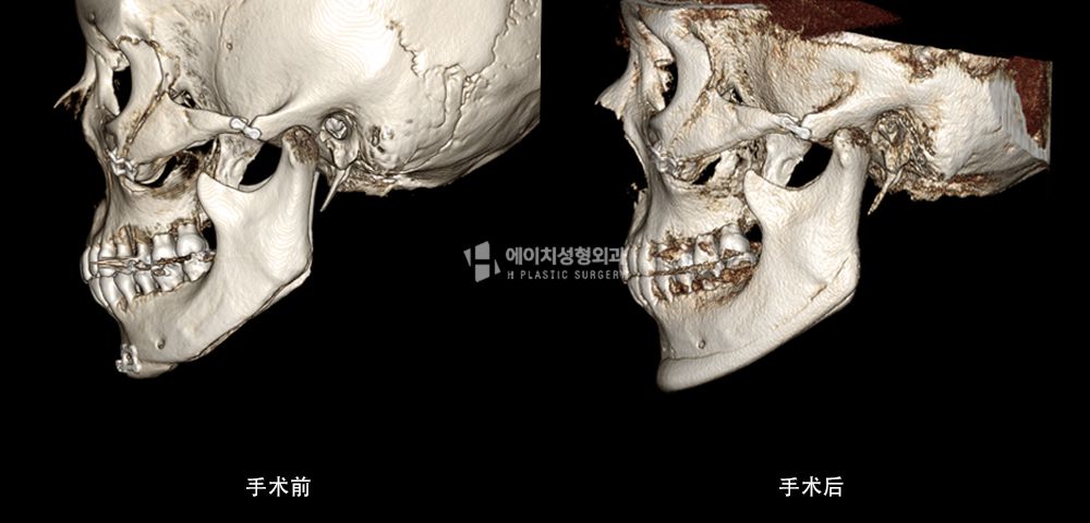 3D FIT 下颌角修复手术案例3(图12)