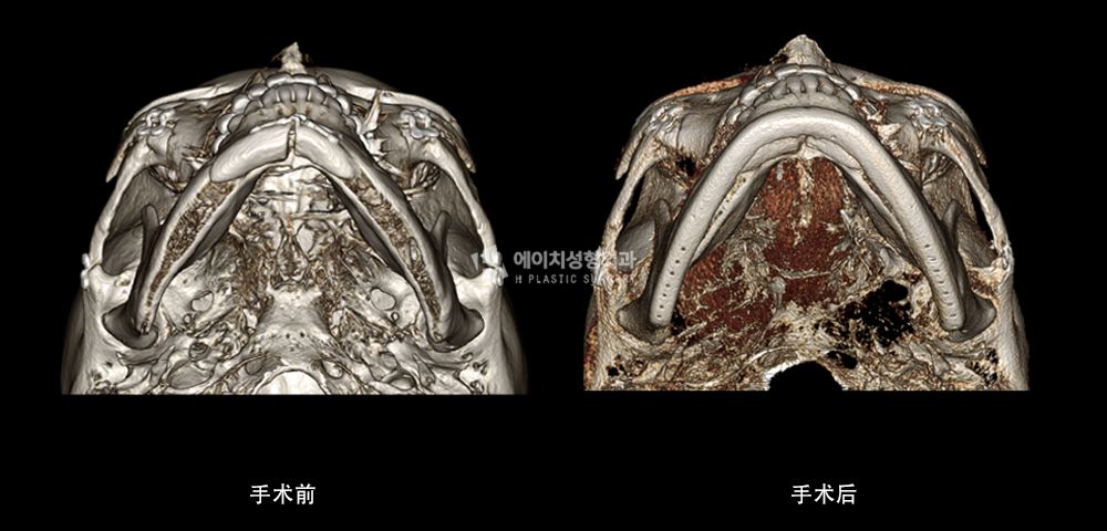 3D FIT 下颌角修复手术案例3(图14)