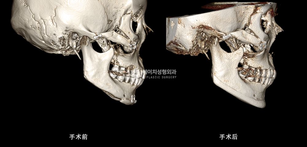 3D FIT 下颌角修复手术案例3(图13)