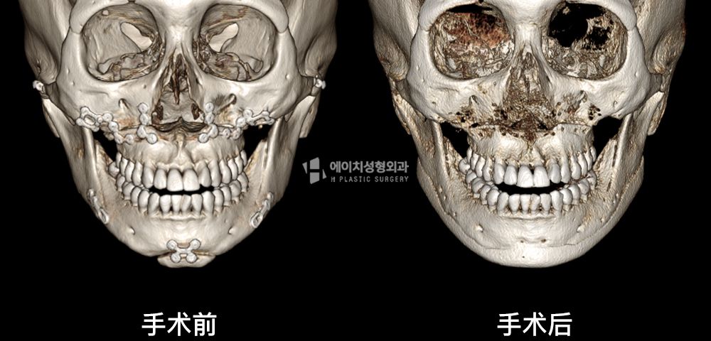 3D FIT 下颌角修复手术案例四(图11)