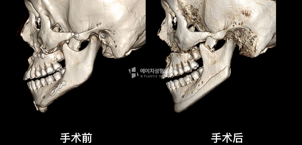 3D FIT 下颌角修复手术案例四(图13)