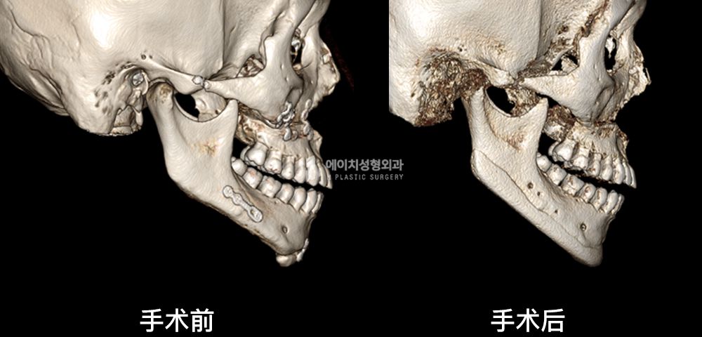 3D FIT 下颌角修复手术案例四(图19)