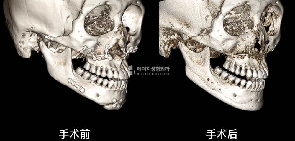 3D FIT 下颌角修复手术案例四(图21)
