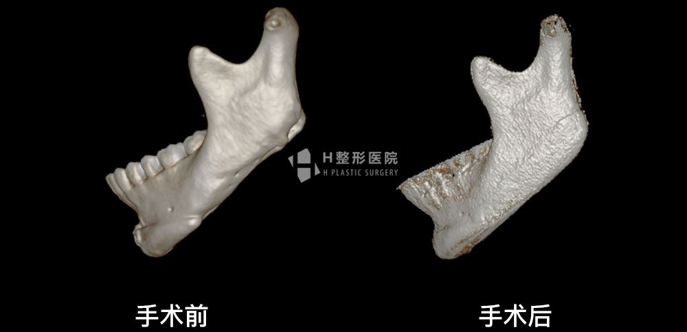 3D FIT 下颌角修复手术案例2(图3)
