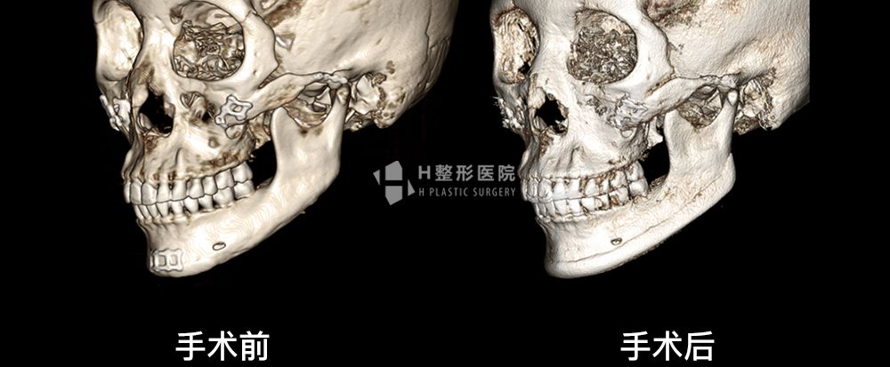 3D FIT下颌角重建修复手术(图10)
