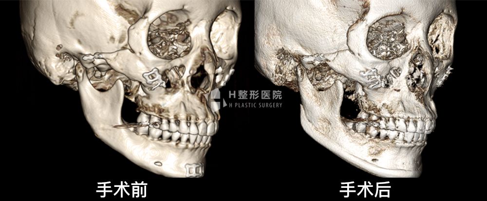 3D FIT下颌角重建修复手术(图8)
