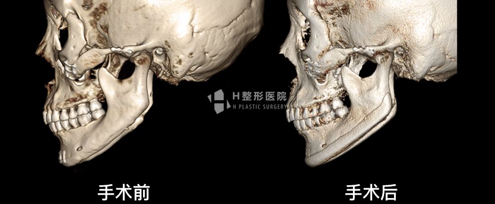 3D FIT下颌角重建修复手术(图11)