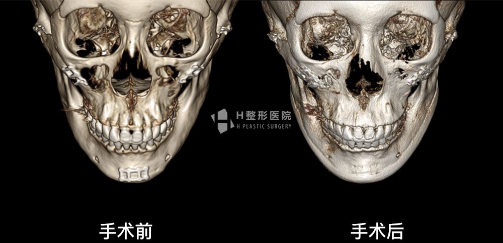 3D FIT下颌角重建修复手术(图13)