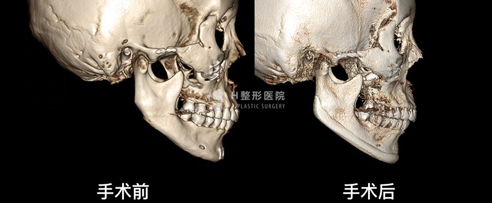 3D FIT下颌角重建修复手术(图9)
