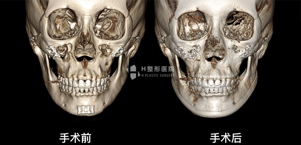 3D FIT下颌角重建修复手术(图12)
