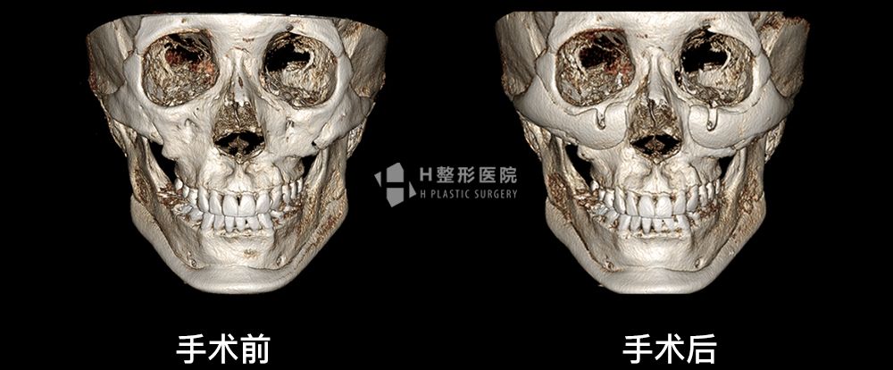 3D FIT颧骨修复手术、再次手术案例3(图2)