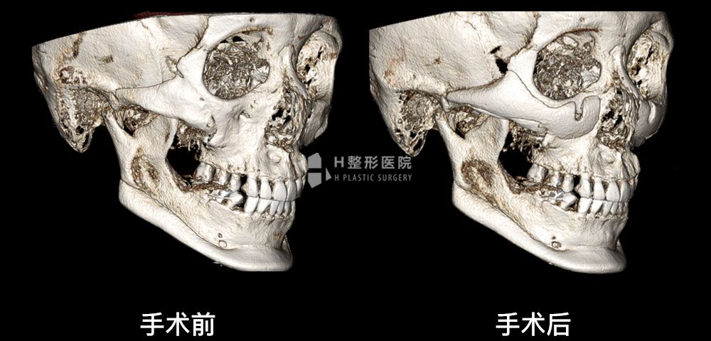 3D FIT颧骨修复手术、再次手术案例3(图3)