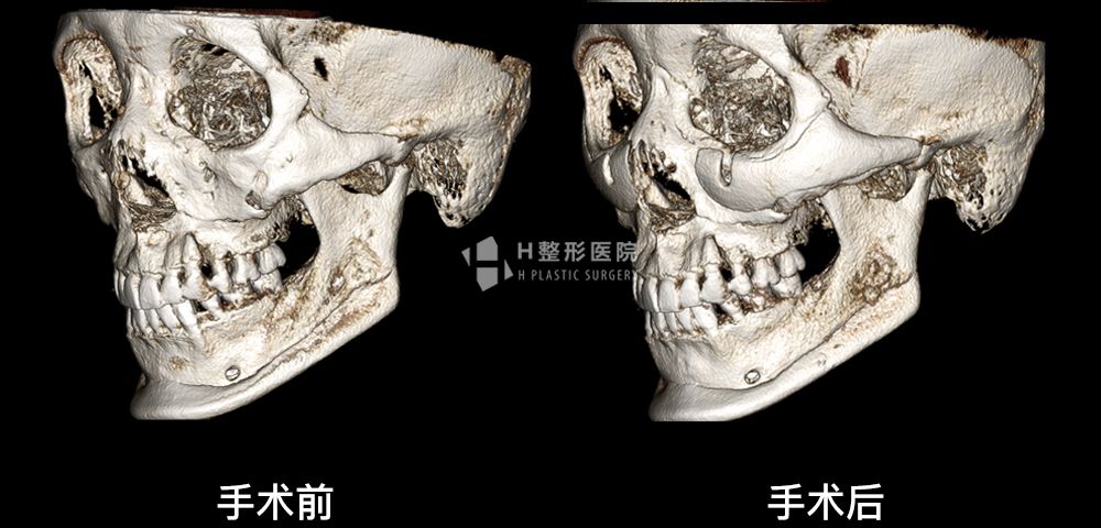 3D FIT颧骨修复手术、再次手术案例3(图1)