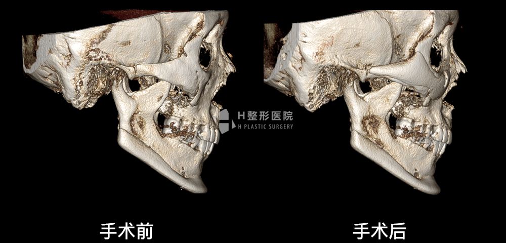 3D FIT颧骨修复手术、再次手术案例3(图5)