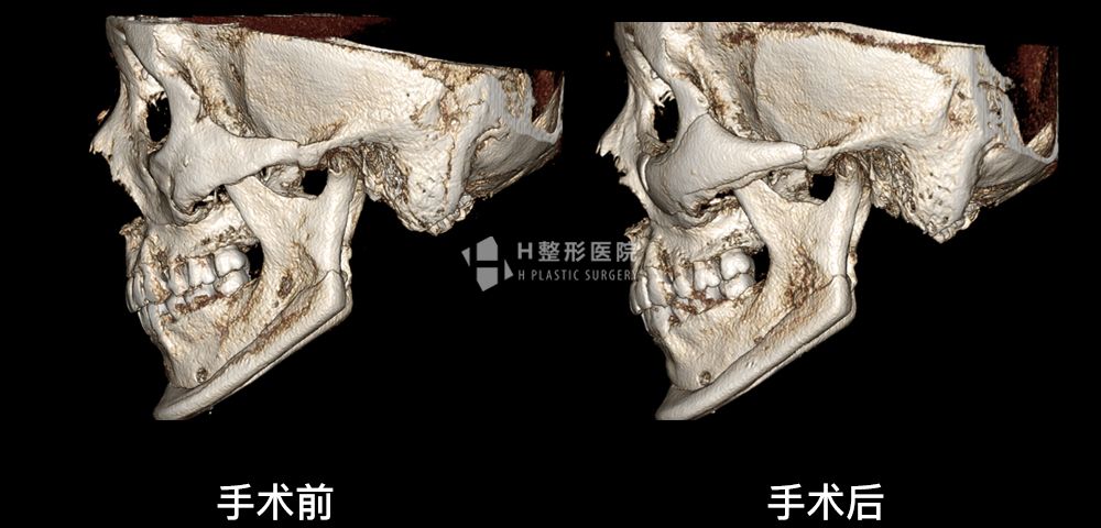 3D FIT颧骨修复手术、再次手术案例3(图4)