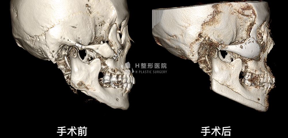 3D FIT颧骨修复手术、再次手术案例4(图4)