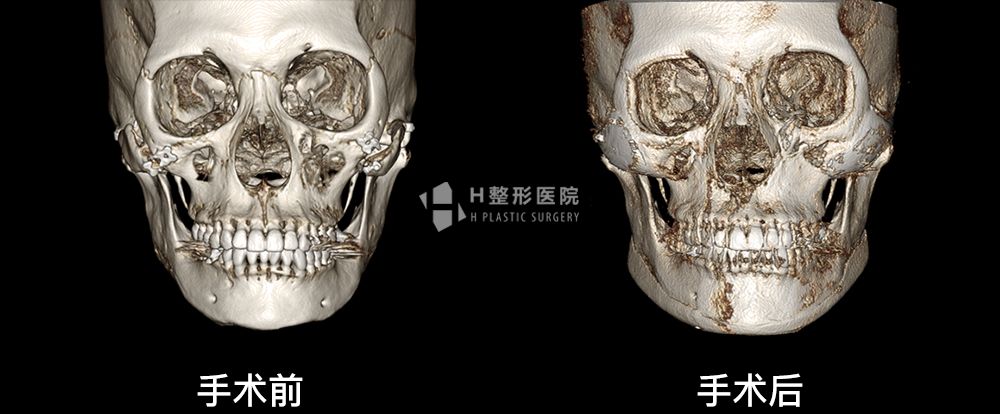 3D FIT颧骨修复手术、再次手术案例4(图3)