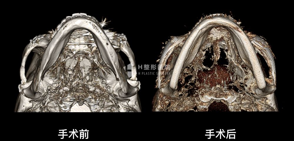 3D FIT颧骨修复手术、再次手术案例4(图1)