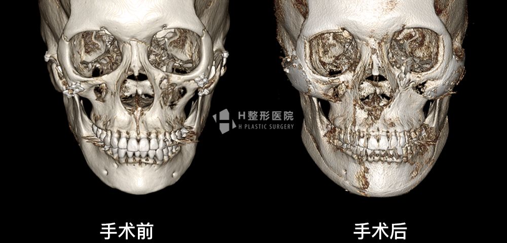 3D FIT颧骨修复手术、再次手术案例4(图2)