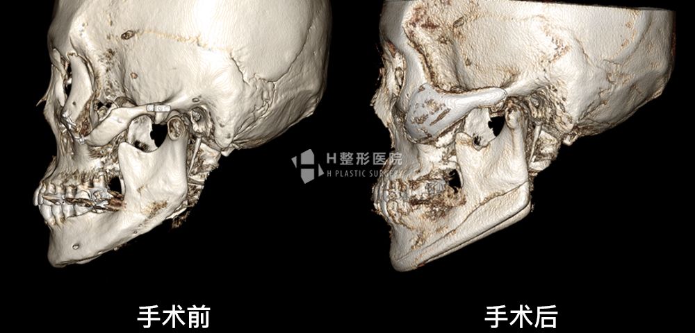 3D FIT颧骨修复手术、再次手术案例4(图5)