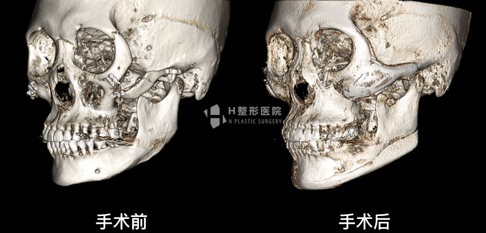 3D FIT颧骨修复手术、再次手术案例4(图7)