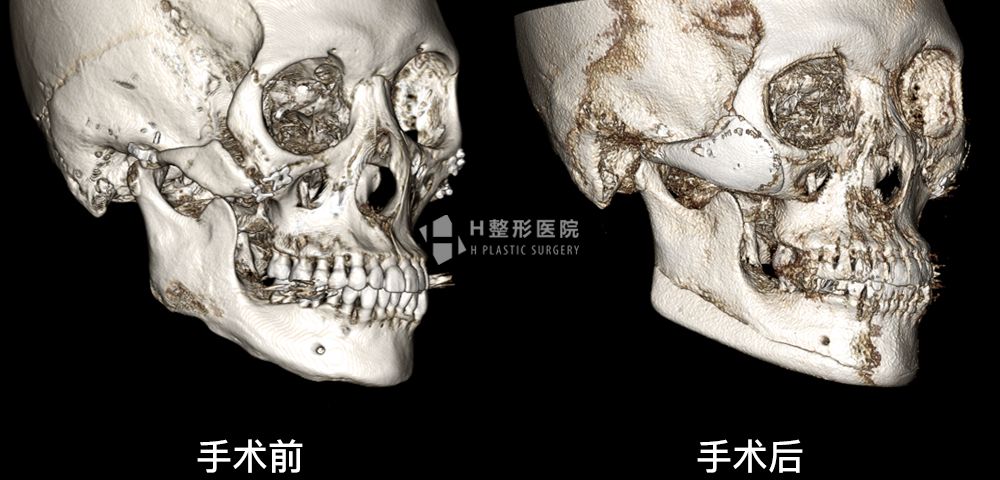 3D FIT颧骨修复手术、再次手术案例4(图6)