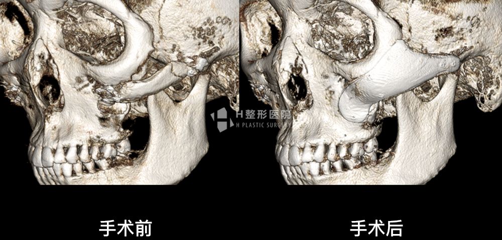 FIT颧骨修复手术、再次手术案例1(图5)