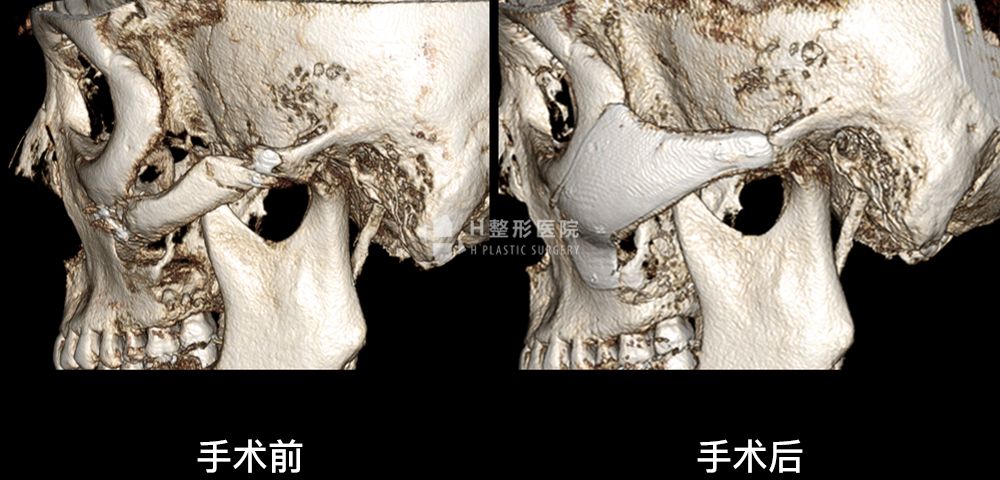 FIT颧骨修复手术、再次手术案例1(图4)