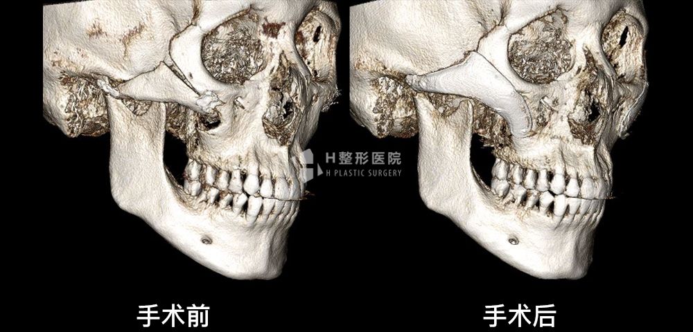 FIT颧骨修复手术、再次手术案例2(图2)