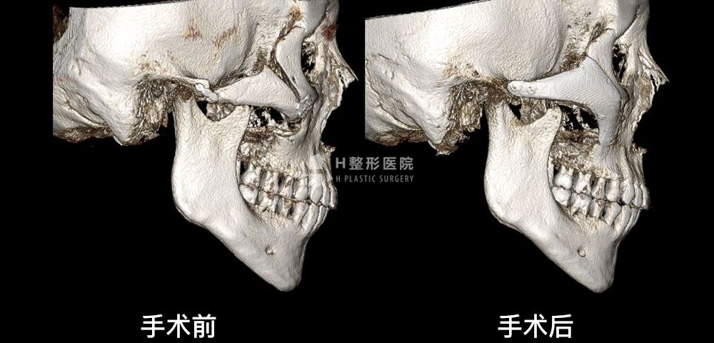 FIT颧骨修复手术、再次手术案例2(图4)