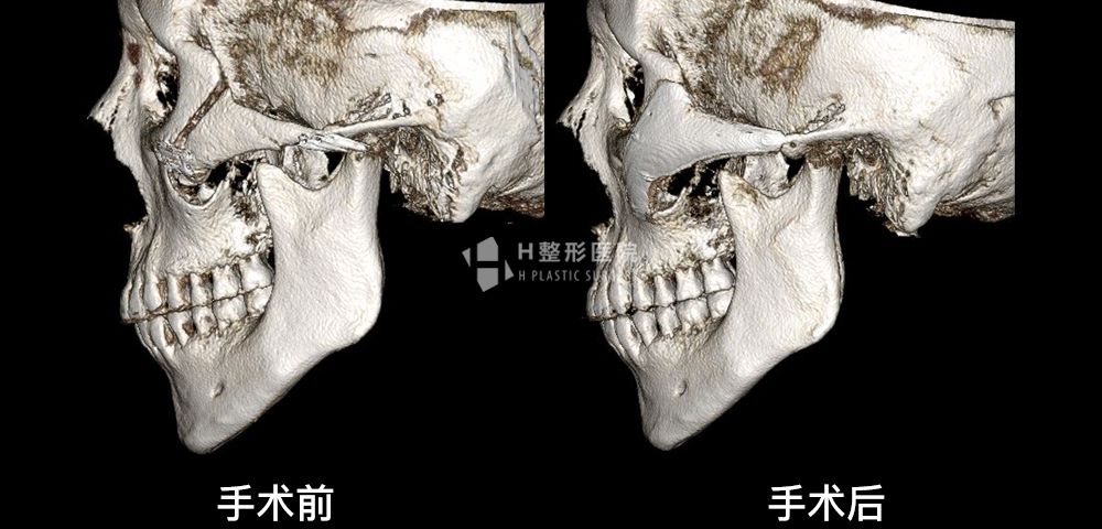 FIT颧骨修复手术、再次手术案例2(图6)