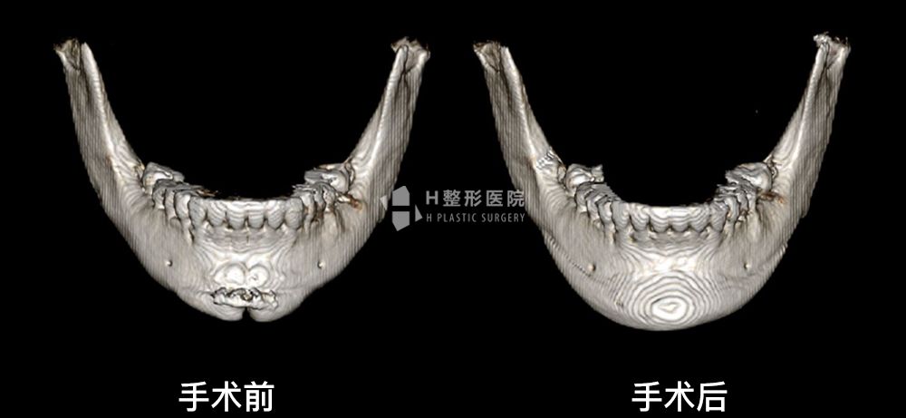 3D FIT下巴修复手术、再次手术案例3(图1)