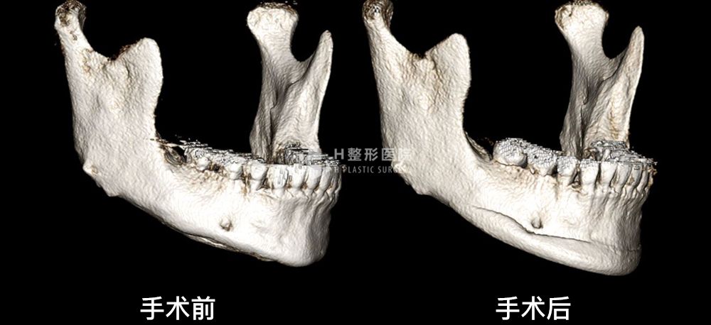 3D FIT下巴修复手术、再次手术案例4(图9)