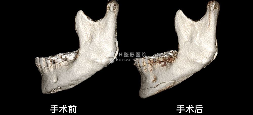 3D FIT下巴修复手术、再次手术案例4(图5)