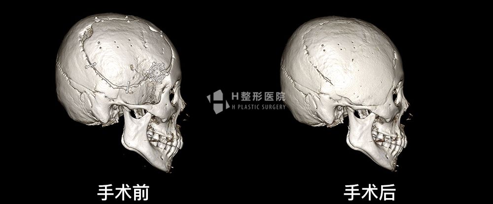 3D FIT头型整形案例1(图5)