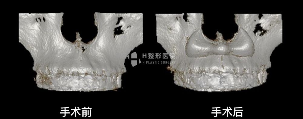 3D FIT贵族小猫手术案例4(图4)