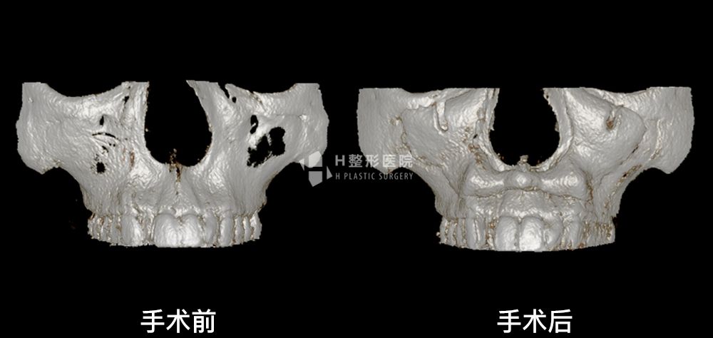 FIT前颧骨假体植入手术案例2(图4)