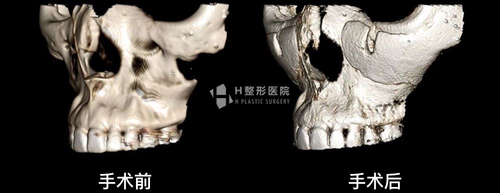FIT前颧骨假体植入手术案例3(图5)